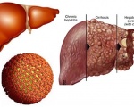 Bệnh viêm gan B và những điều có thể bạn chưa biết
